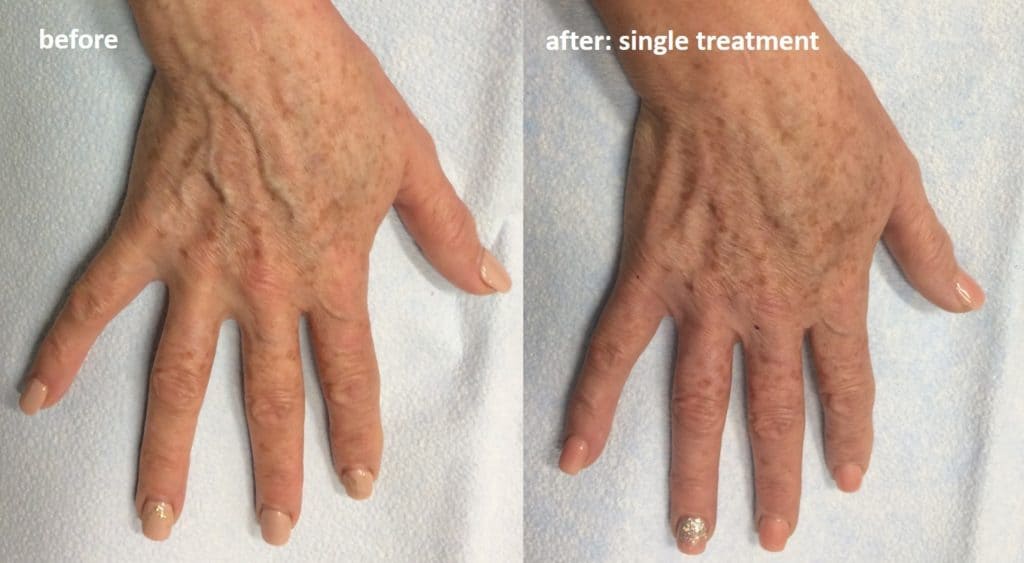 Hand vein treatment before and after