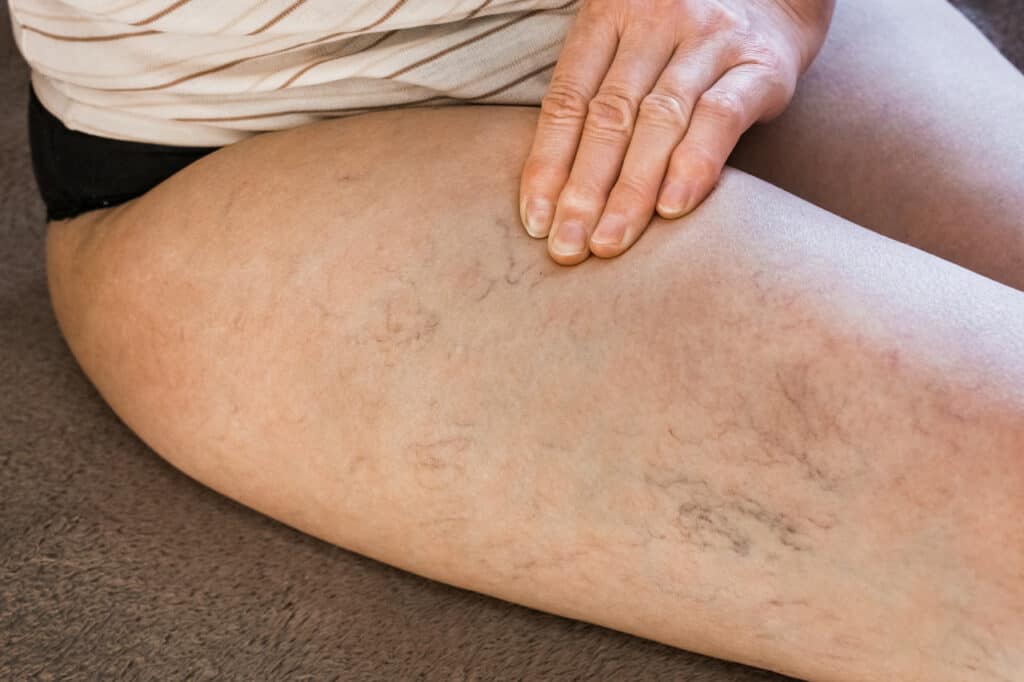 Sclerotherapy
