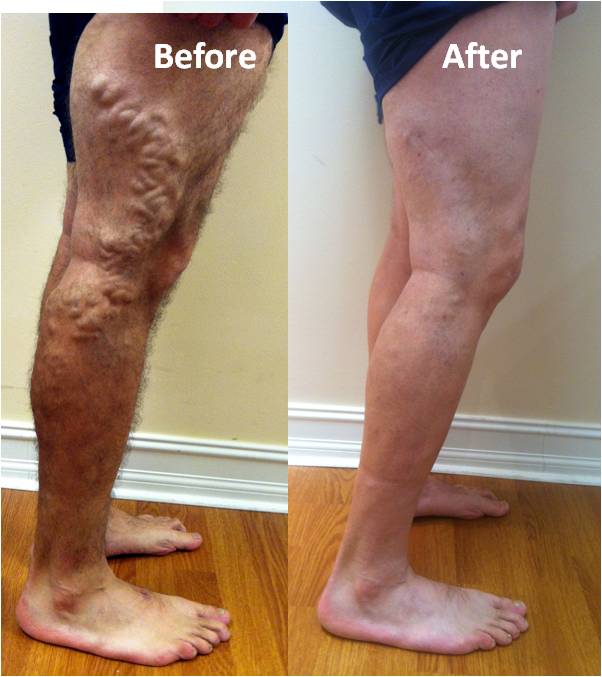 varicose veins insurance
