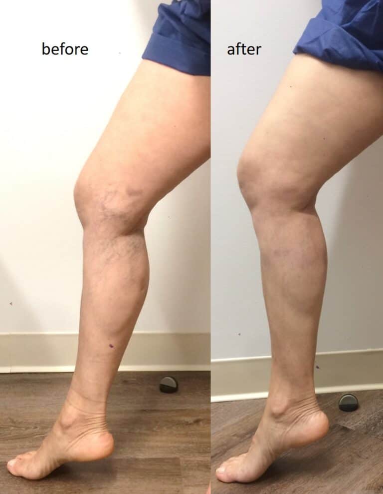 spider veins treatment near me