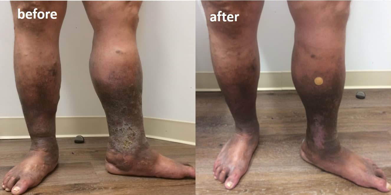 Venous Ulcer Before and After Treatment